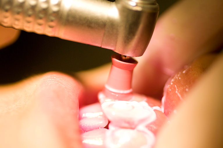 PMTC（歯医者さんで本格的に行う歯のクリーニング）